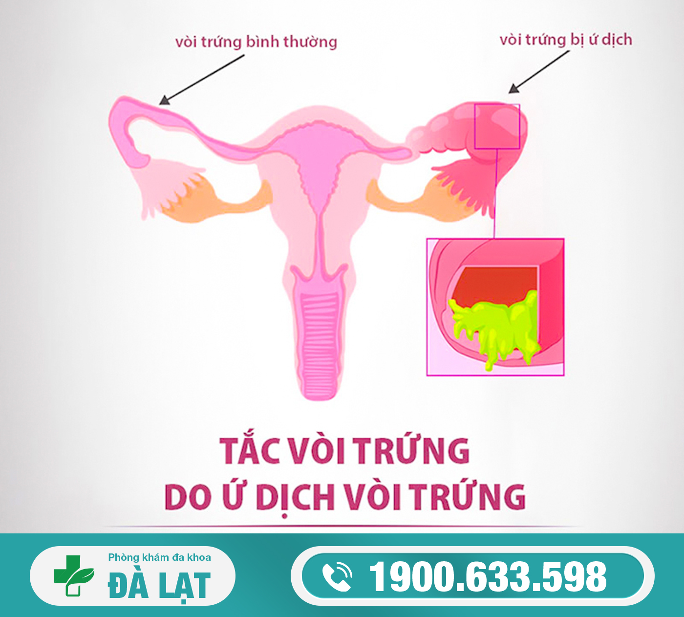 Tắc vòi trứng là gì? Nguyên nhân của tắc vòi trứng